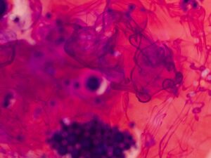 Enfermedad Tromboembólica Venosa en el paciente con cáncer