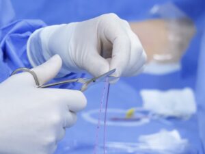 Catéteres vasculares en la terapia oncológica